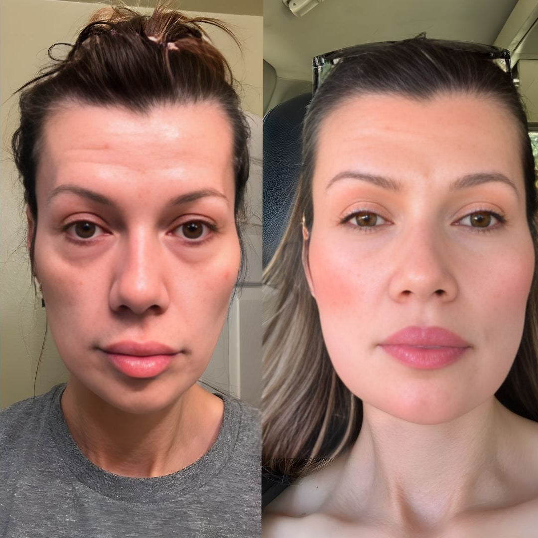 Resultados de antes y después usando Eye Relax Brow: reducción visible de bolsas, ojeras y líneas de expresión tras 5 semanas de uso.